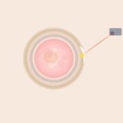 Assisted-Hatching Assisted Hatching: Schlüpfhilfe für Embryonen bei IVF & ICSI
