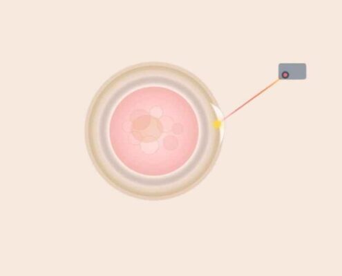 Assisted Hatching: Schlüpfhilfe für Embryonen bei IVF & ICSI